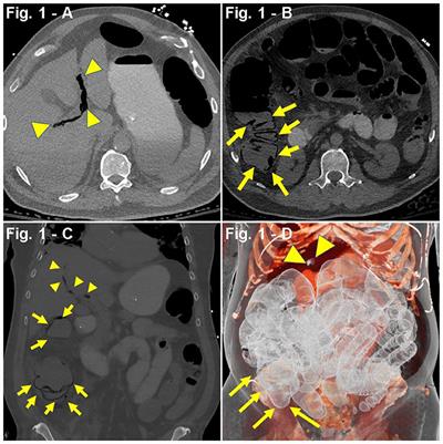 Pneumatosis Intestinalis in the Setting of COVID-19: A Single Center Case Series From New York